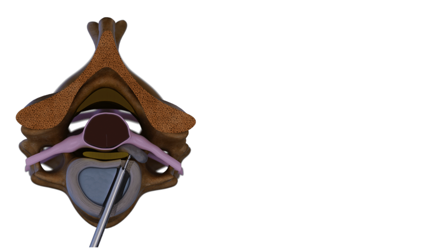 Anterior transdiskal surgical technique