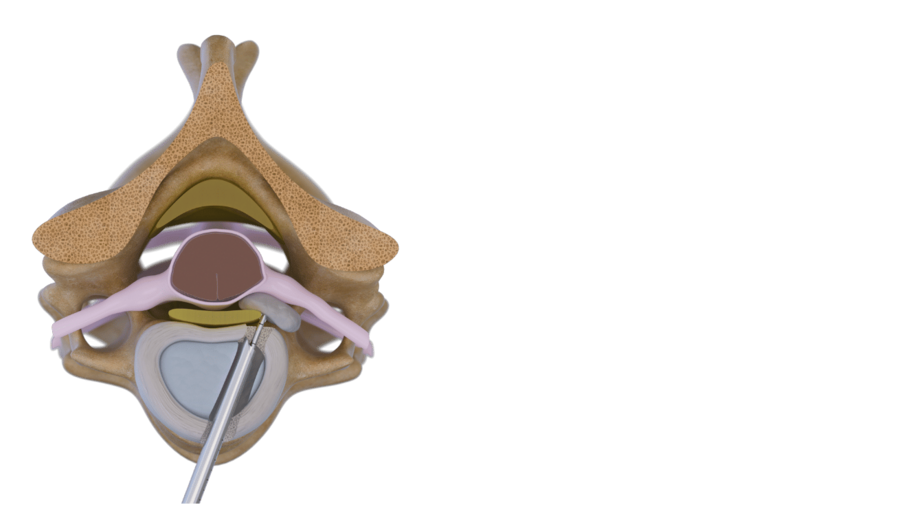 anterior-transdiskale-endoskopie-halswirbelsaeule-riwospine.png Anterior transdiskal surgical technique