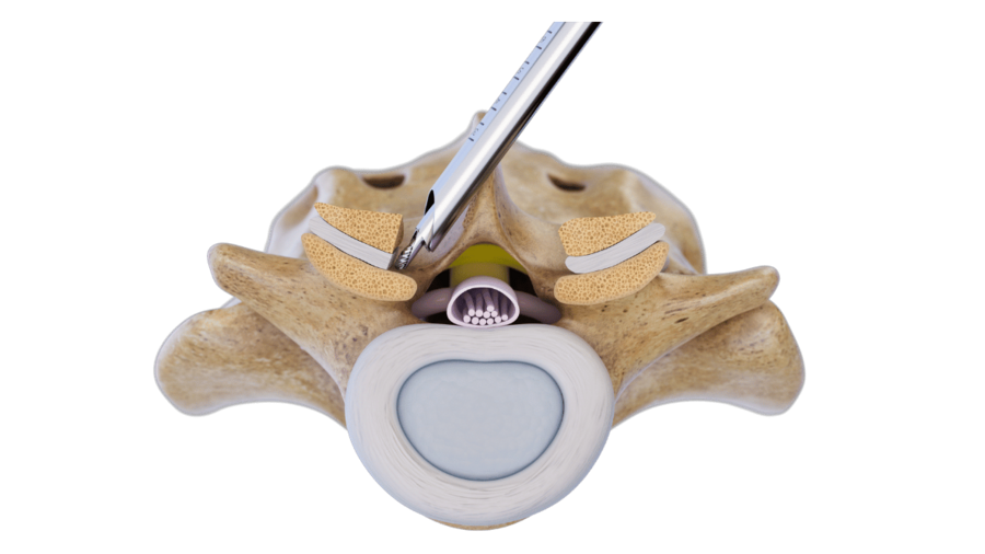 3D graphic of a spine and a RIWOspine instrument illustrating the over-the-top technique for contralateral decompression