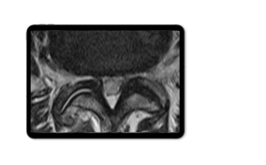 Tablet mockup showing an X-ray image of lateral recess stenosis.