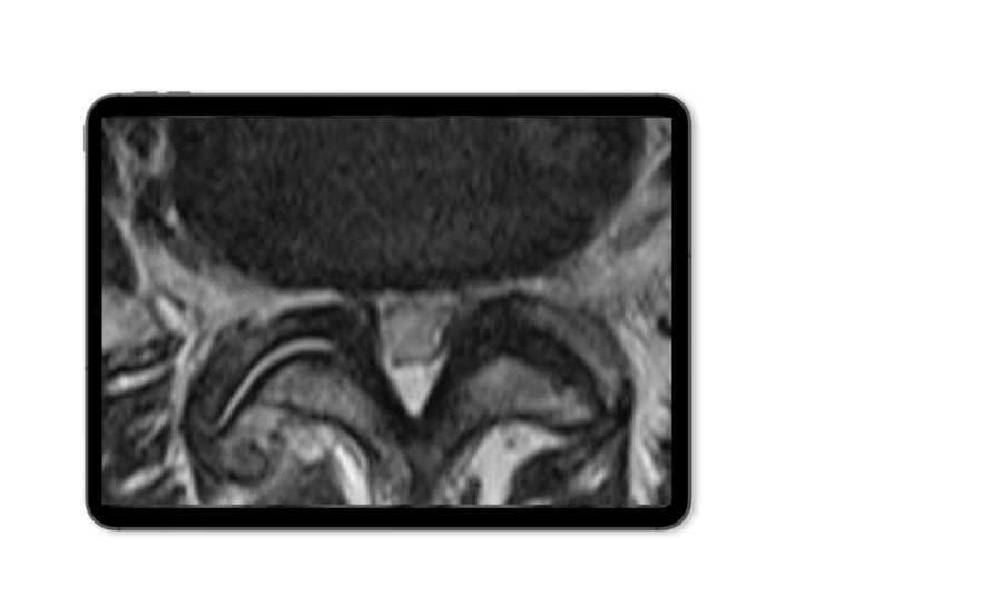 rezessusstenose-mrt-riwospine.png Mockup eines Tablets zeigt ein Röntgenbild mit einer lateralen Rezessusstenose der Wirbelsäule