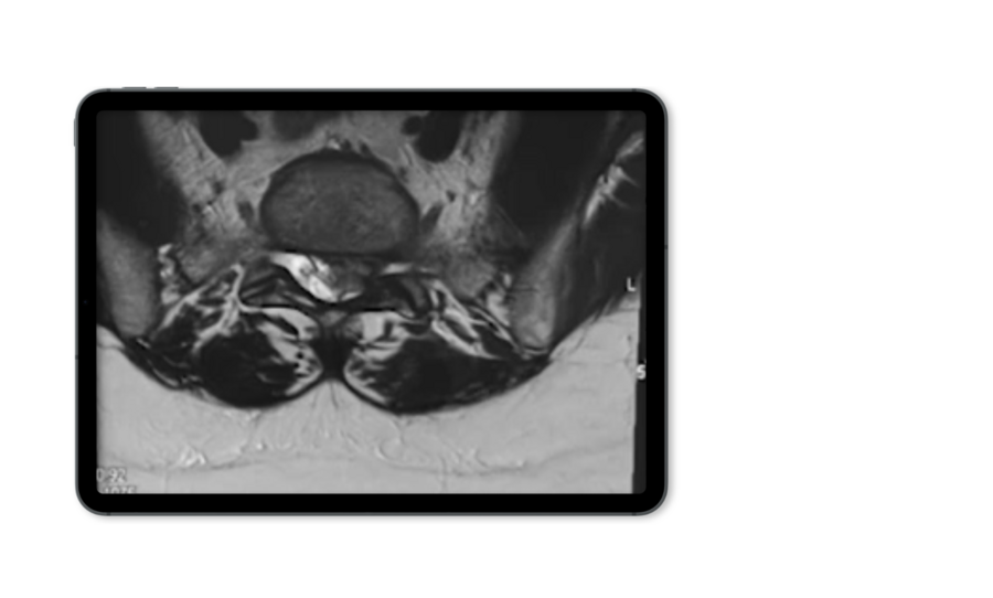 interlaminar-disc-herniation-mri-riwospine.png Herniated disc X-ray displayed on tablet mockup