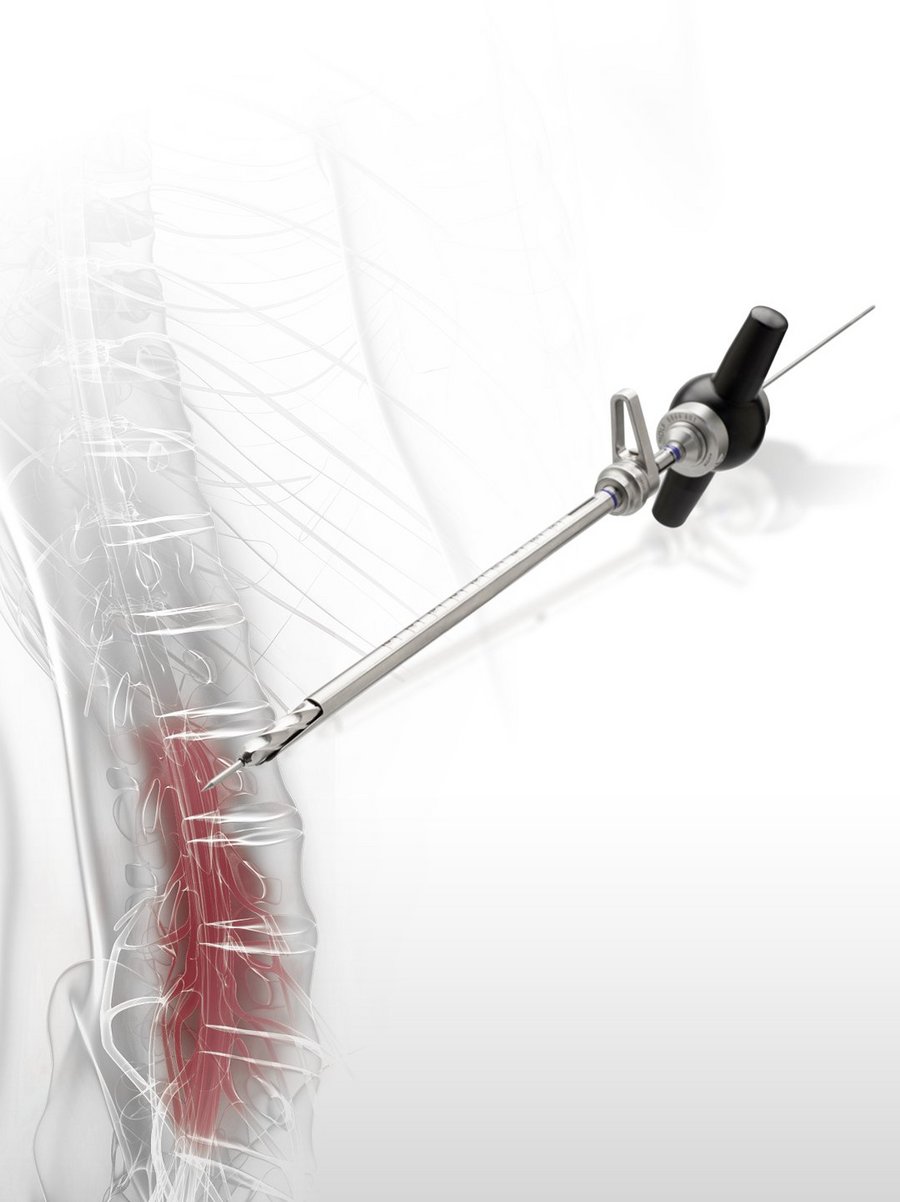 riwospine-vertebris-foraminotomy-manual-drilling-system.png VERTEBRIS Foraminotomy manual drilling system with ergonomic design and neural protection
