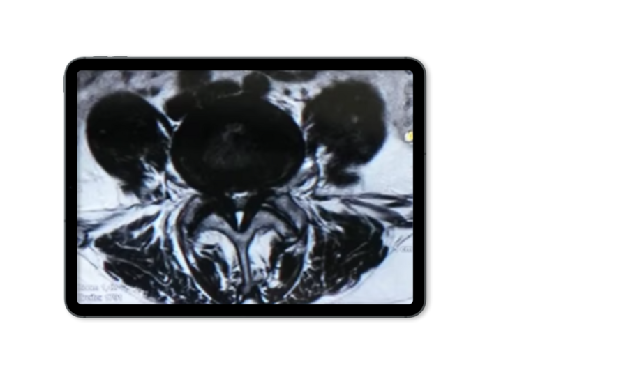 Tablet mockup showing an X-ray image of central stenosis.