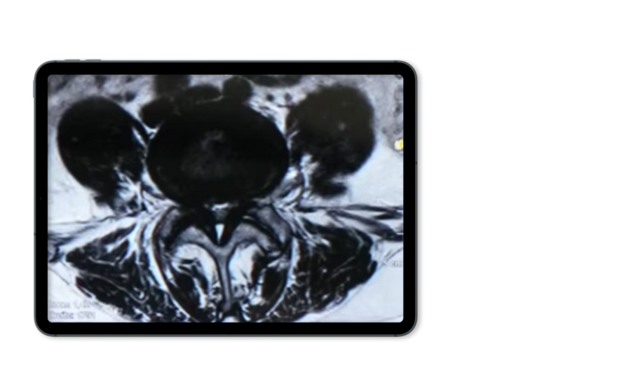 zentrale-spinalkanalstenose-mrt-riwospine.png Mockup eines Tablets zeigt ein Röntgenbild mit einer zentralen Stenose der Wirbelsäule.