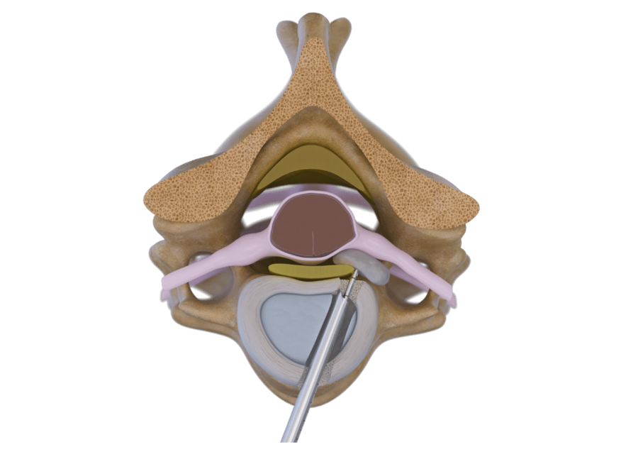 Anteriore Halswirbelsäulentechnik mit RIWOspine zur Behandlung von Bandscheibenvorfällen