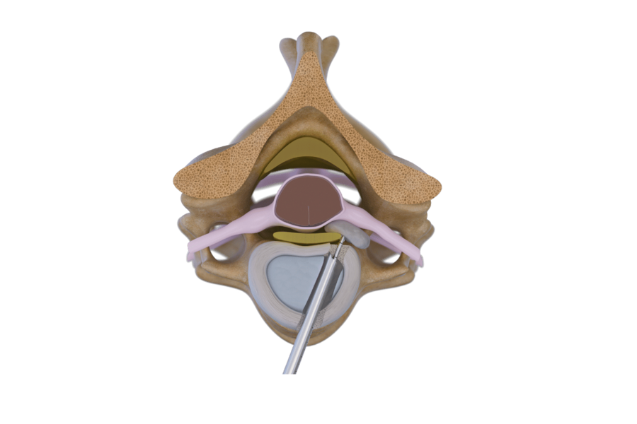 riwospine-anterior-cervical-technique-herniated-disc.png Anterior cervical spine surgery technique with RIWOspine for herniated disc treatment