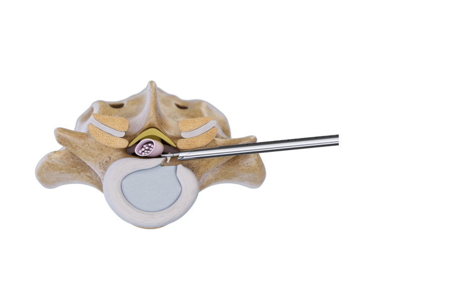 foraminal-technique-endoscopic-spine-surgery-riwospine.png Spine cross-section graphic showing instrument treating disc herniation via foraminal technique