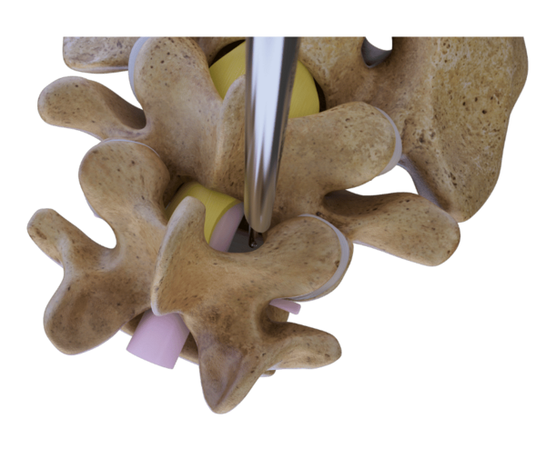 Endoscopic access to lumbar spine from superior view for spinal stenosis decompression