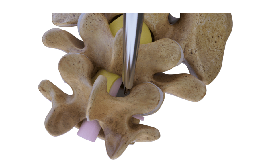 Endoskopischer Zugang zur Lendenwirbelsäule aus oberer Ansicht bei Spinalkanalstenose