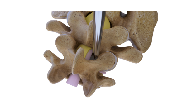 Endoskopischer Zugang zur Lendenwirbelsäule aus oberer Ansicht bei Spinalkanalstenose