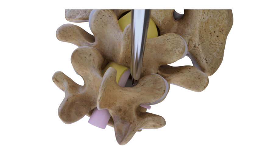 ipsilaterale-dekompression-wirbelsaeule-riwospine.png Endoskopische ipsilaterale Dekompression der Lendenwirbelsäule