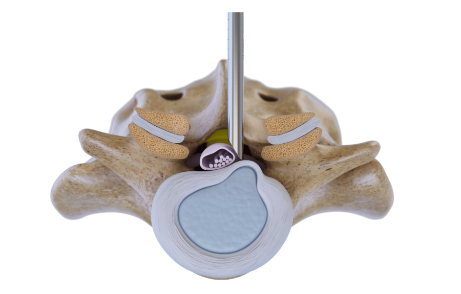 Posteriore Technik zur Halswirbelsäulenchirurgie mit VERTEBRIS-System von RIWOspine