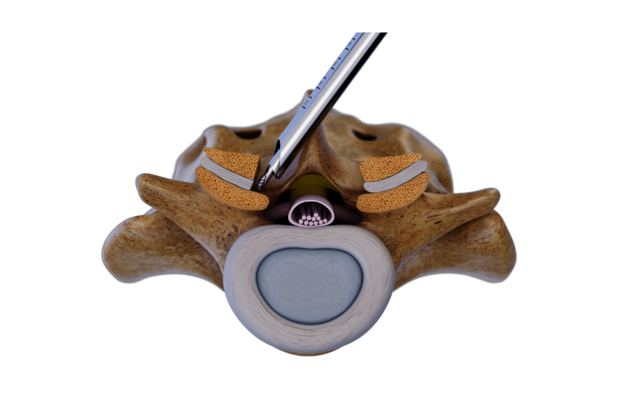 Over-the-top technique Contralateral decompression