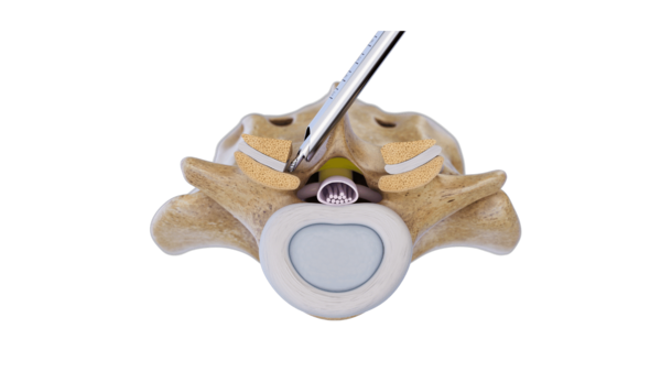 Over-the-top endoscopic technique for contralateral decompression in spinal stenosis