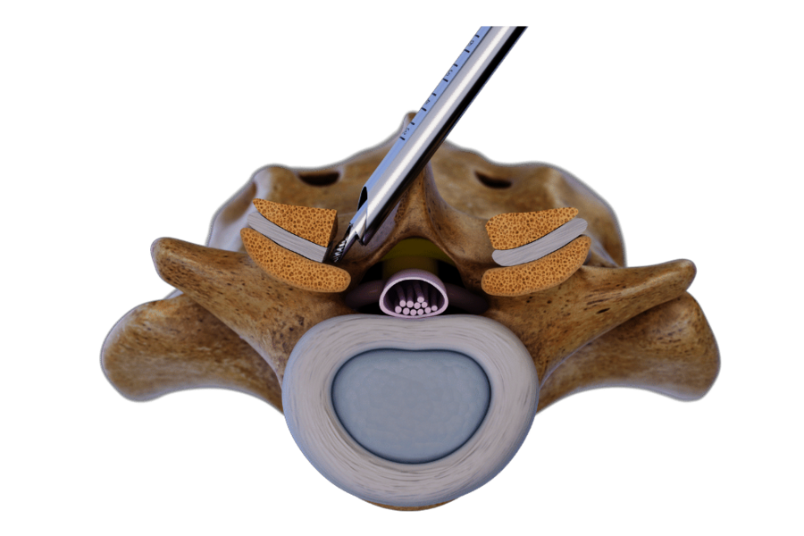 Over-the-top technique Contralateral decompression