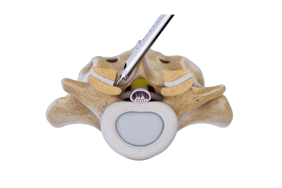Over-the-top technique  Contralateral decompression