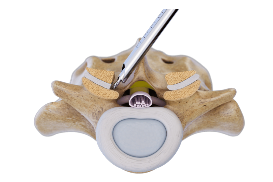 riwospine-over-the-top-contralateral-decompression-technique.png Over-the-top technique Contralateral decompression