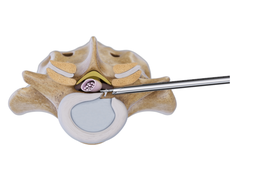 Transforaminal endoscopic access to lumbar spine with VERTEBRIS technique