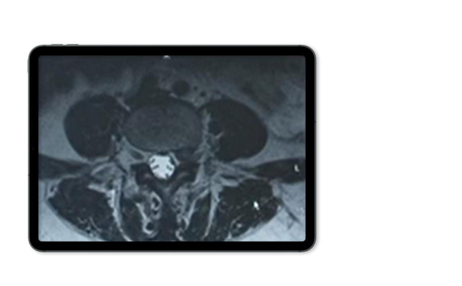 Tablet mockup showing an X-ray image of foraminal stenosis.