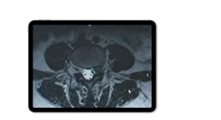 foraminal-stenosis-mri-riwospine.png Foraminal disc herniation X-ray on tablet mockup display