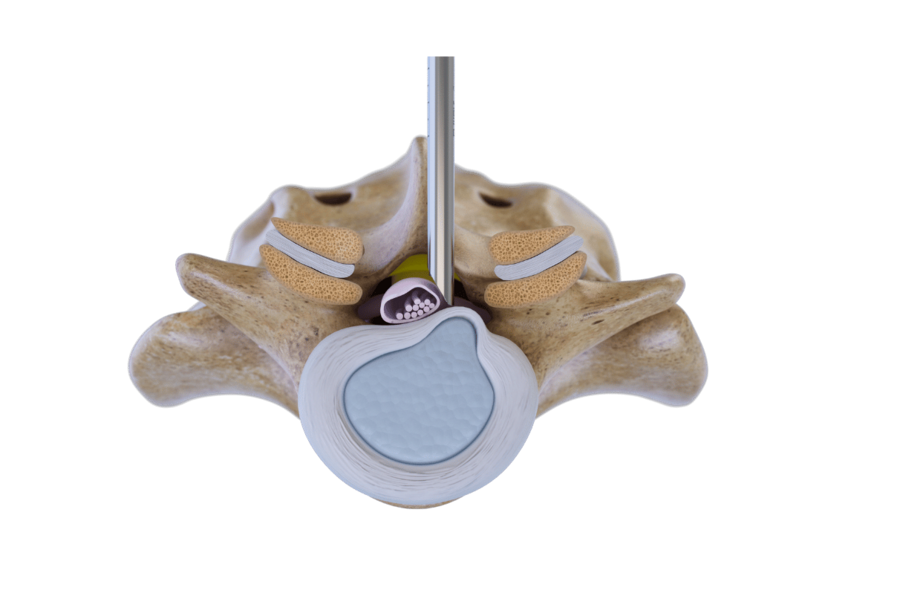 Endoscopic interlaminar access to lumbar spine using VERTEBRIS system