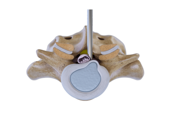 Endoskopischer interlaminärer Zugang zur Lendenwirbelsäule mit VERTEBRIS-System
