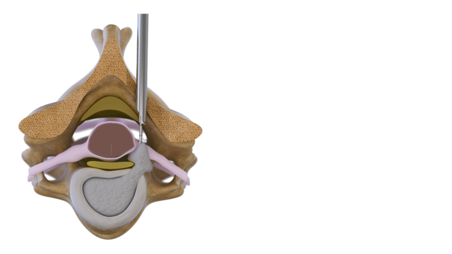 posterior-cervical-endoskopie-bandscheibenvorfall-riwospine.png Posterior cervical Surgical Technique