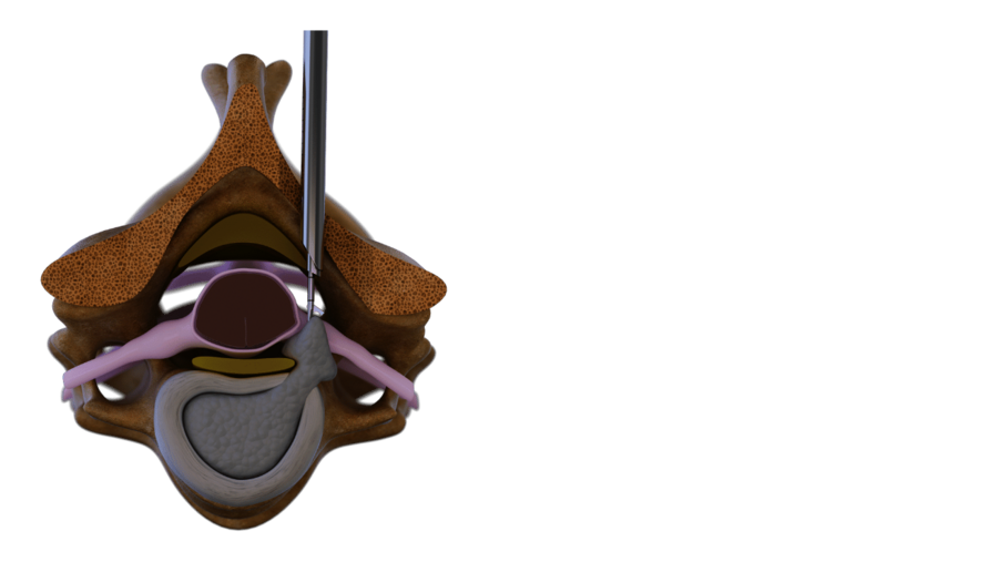 Posterior cervical Surgical Technique