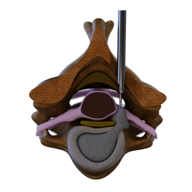 Posterior cervical Surgical Technique
